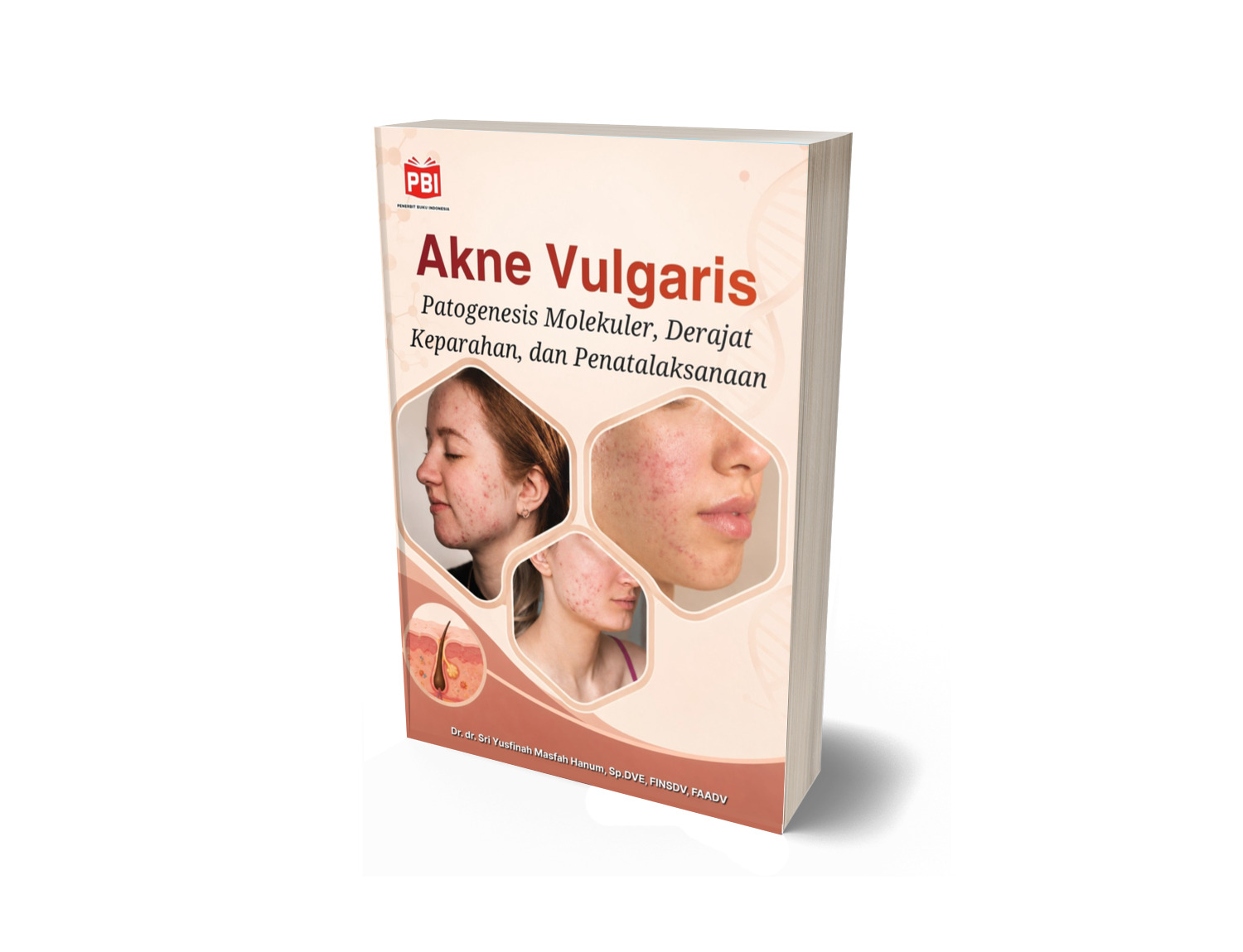 AKNE VULGARIS Patogenesis Molekuler, Derajat Keparahan, dan Penatalaksanaan
